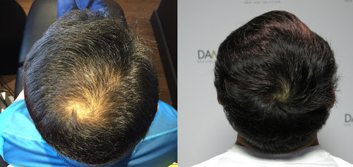 Damo Hair Loss Solution